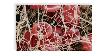 the clot make it appear red 4. Fibrin threads form and trap red cells.