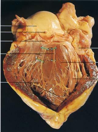AV Bundle Branch, Left Side Aortic sinus Opening into left coronary artery Aortic valve The left Bundle Branch Purkinje fibers Left auricle Interventricular