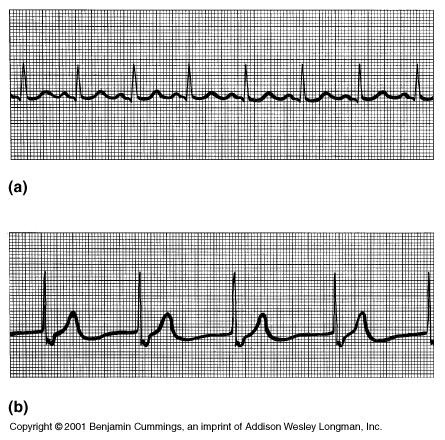 P R T Figure 18.18 Normal ECG Q S Absent P wave due to non-functioning SA node AV node becomes an ectopic pacemaker 61 In tracing (b) there is no P wave because the SA node is not functioning.