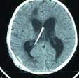 Guidelines for Management of Severe TBI, 4 th ed CSF DRAINAGE Level I Level IIA Level III PEDIATRIC GUIDELINES EVD system zeroed at midbrain with continuous drainage may be considered to lower ICP