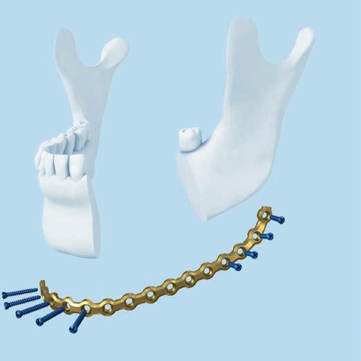 Steps for Bone Resection (Optional) 11 Resect the mandible Instruments 313.252 Screwdriver Shaft PlusDrive 1.5/2.0, long, self-holding, for Hexagonal Coupling 311.