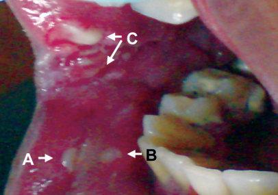 Intra oral examination revealed smaller ulcers on lower labial mucosa with diameter approximately 6 mm (Figure 2-A) and 5 mm (Figure 2-B).