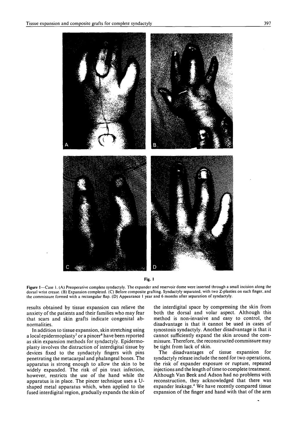 Tissue expansion and composite grafts for complete syndactyly 397 Fig. 1 Figure l--case I. (A) Preoperative complete syndactyly.