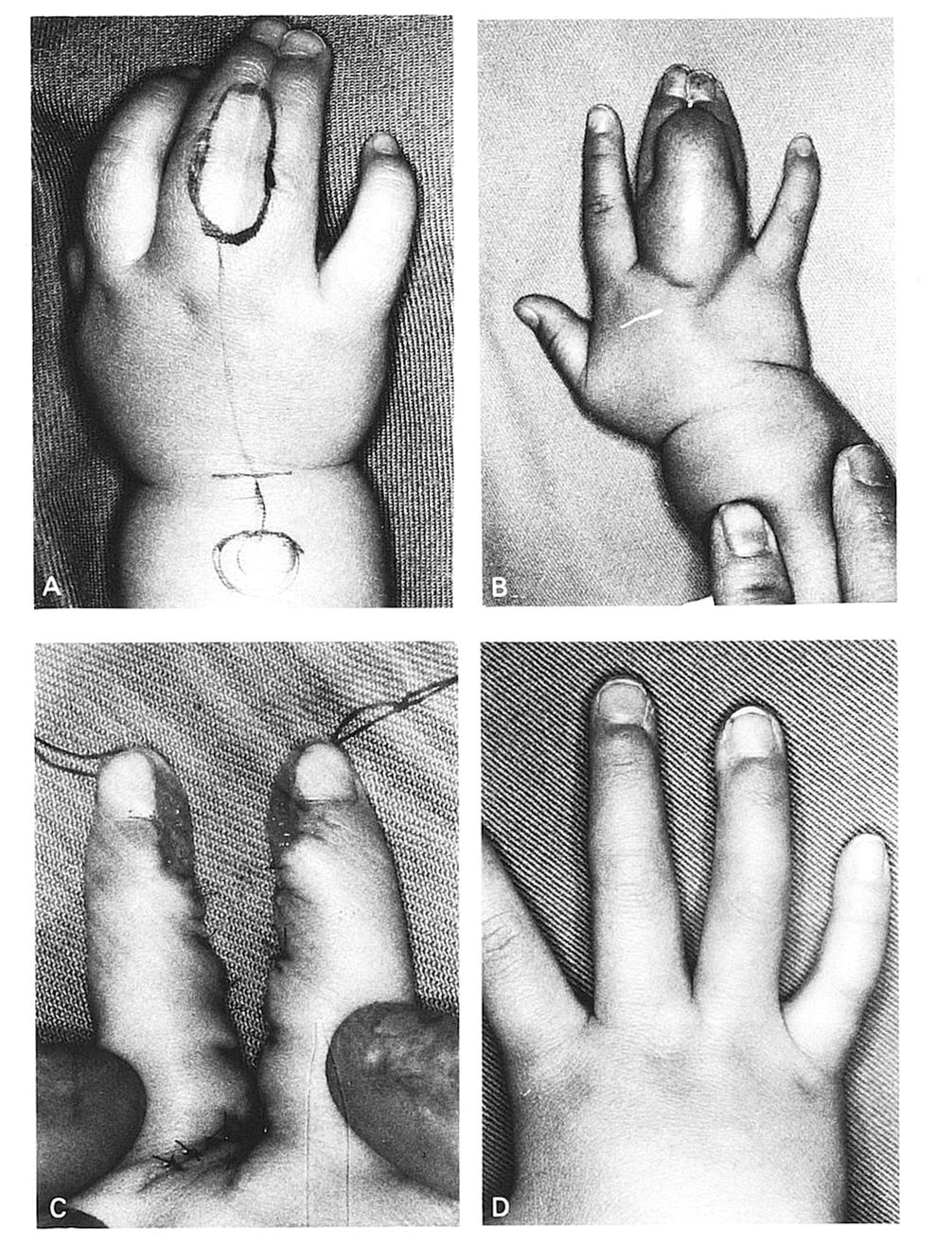 Syndactyly separated, with two Z-plasties on each finger, and the commissure formed with a rectangular flap. (D) Appearance I year and 6 months after separation of syndactyly.