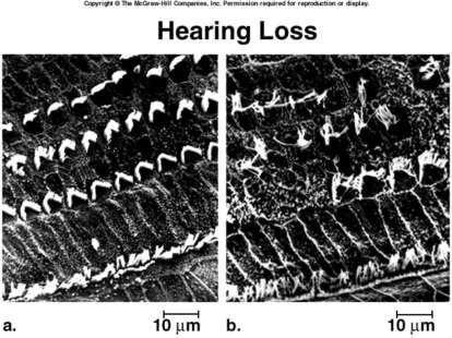 the inner ear. This can be treated with conventional hearing aids, which amplify the overall volume of sound or may enhance certain frequencies.