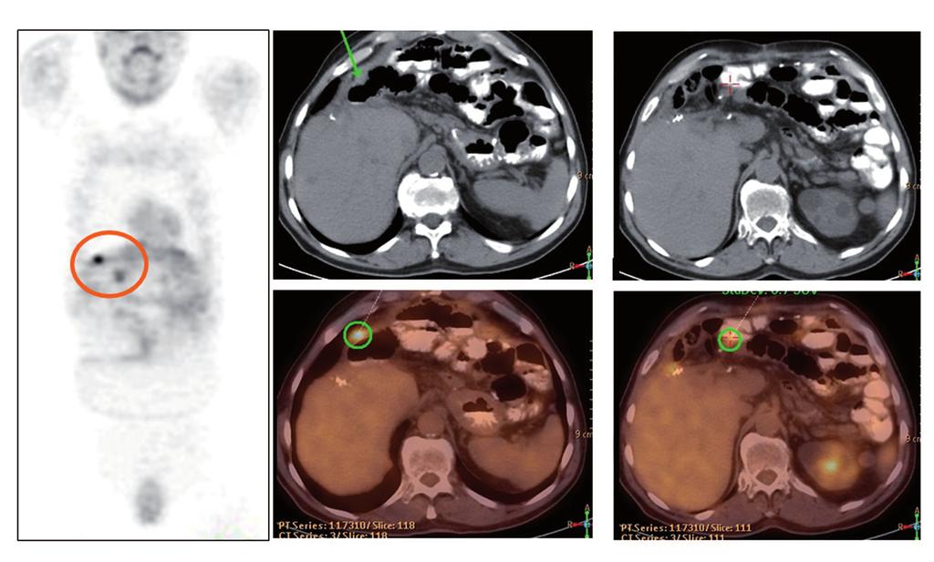 Vol. 104. N. 7, 2012 PATTERNS OF EXTENSION OF GASTROINTESTINAL STROMAL TUMORS (GIST) TREATED WITH 361 IMATINIB (GLEEVEC ) BY 18 F-FDG PET/CT of 10 years.