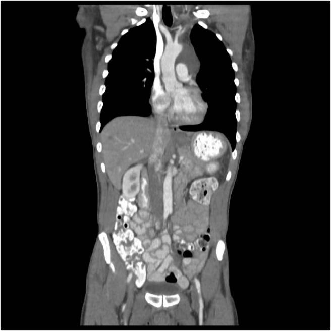 The Figure 10 CT scan showing resolution of tumor at 3 months. differential diagnosis also includes adenocarcinoma, lymphoma, metastatic melanoma and retroperitoneal sarcoma [7].