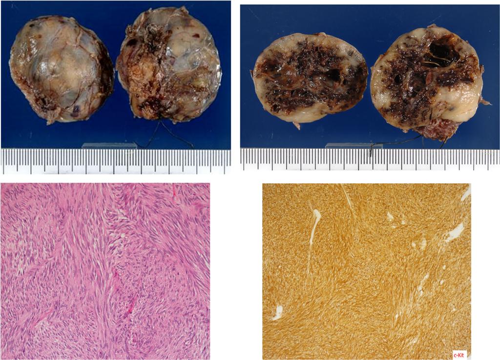Tzw et l. Surgicl Cse Reports (2017) 3:8 Pge 4 of 6 Fig. 4, The resected tumor ws 3.5 3.5 2.5 cm in size. The ruery-hrd tumor with widespred centrl necrosis ws completely cpsulized.