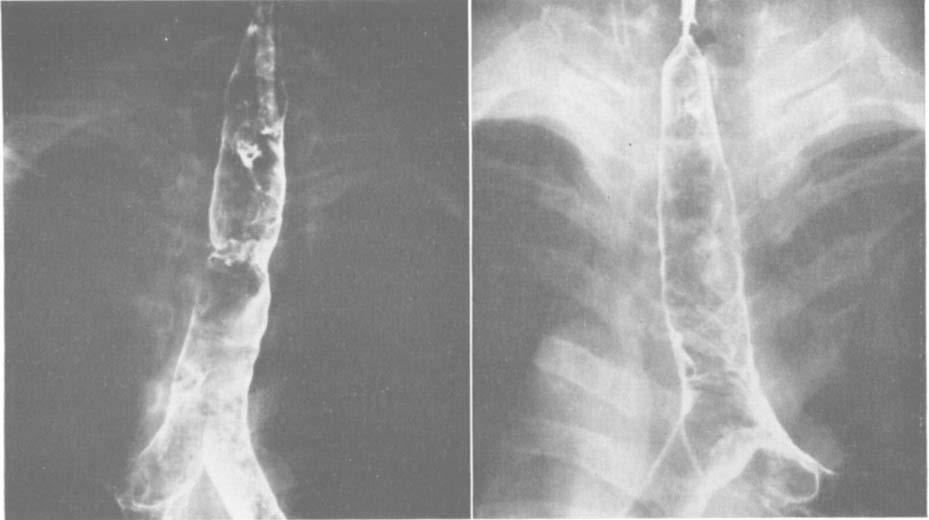 Postintubation Tracheal Stenosis FIG. 1. Tantalum tracheogram taken two years after repeated tracheal dilatation (Case 4).