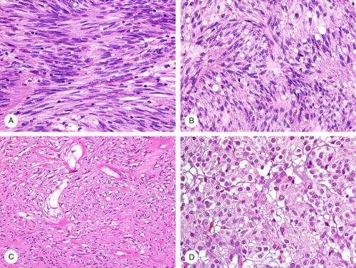 RESULTS: histology Gastric GIST histology was seen in 35 cases including tumors with