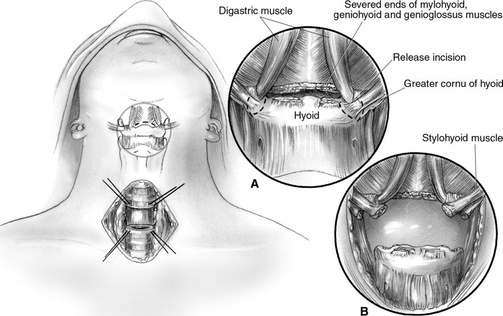 Surgical repair of iatrogenic cervical tracheal stenosis 49 Figure 9 To perform the suprahyoid release, a small transverse incision is made directly over the hyoid bone.