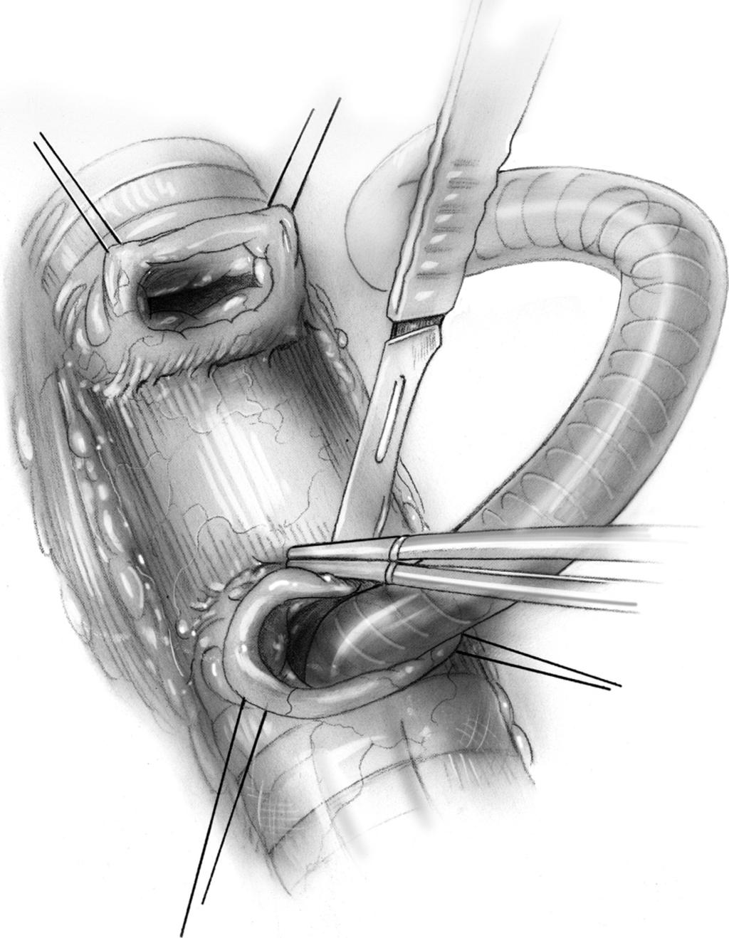 Surgical repair of iatrogenic cervical tracheal stenosis 47 Figure 7 Traction sutures are placed at the free edges of the cut trachea to facilitate retraction.