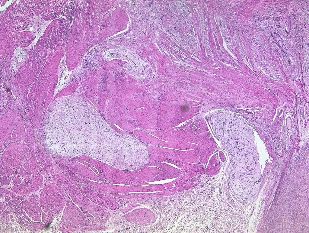 Antral plexiform Fibromyxoma located nearly exclusively in the stomach vascular invasion may occur tumor