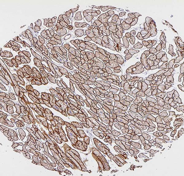 muscle Myometrium Uterine leiomyoma Soft tissue