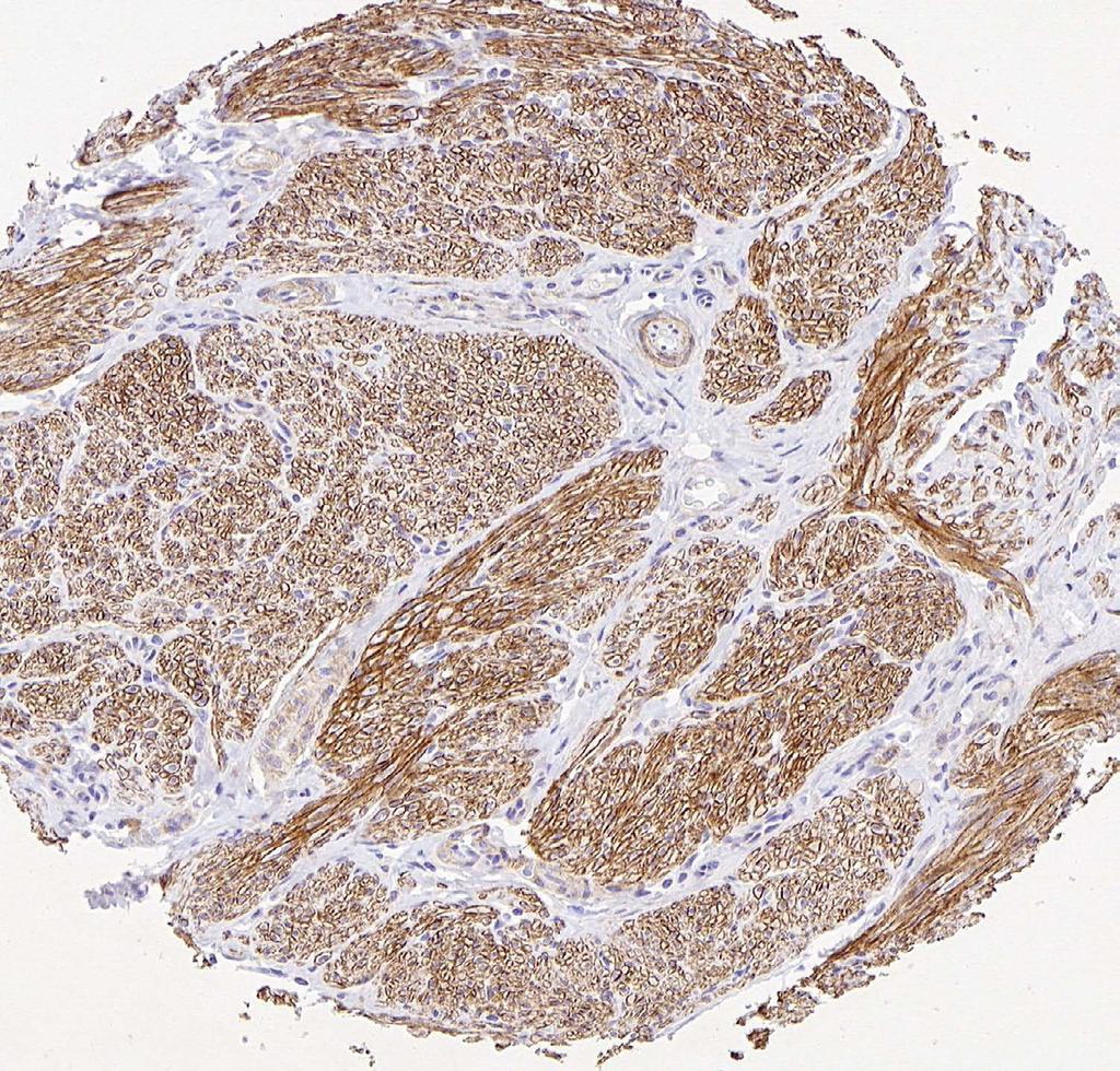 tissue LMS Cardiac LMS b c Dystrophin IHC + - T otals