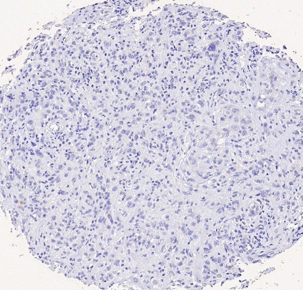 expression assessed by immunohistochemistry in 20