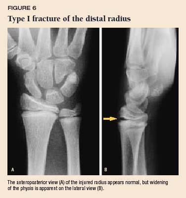 - Colles fracture is a fracture of the distal end of the radius in the forearm with dorsal (posterior) displacement of the wrist and hand (outstretched hand) -Smith s