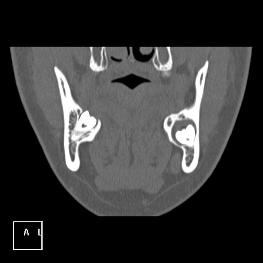 Images for this section: Fig. 1: Panoramic radiography that shows a radicular cyst in the inferior right molar Fig.