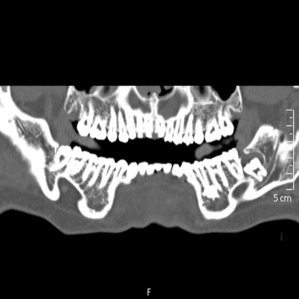 Fig. 5: Odontogenic cyst of 38 tooth in contact with the left inferior dental nerve that can cause prpblems in the exodontia.