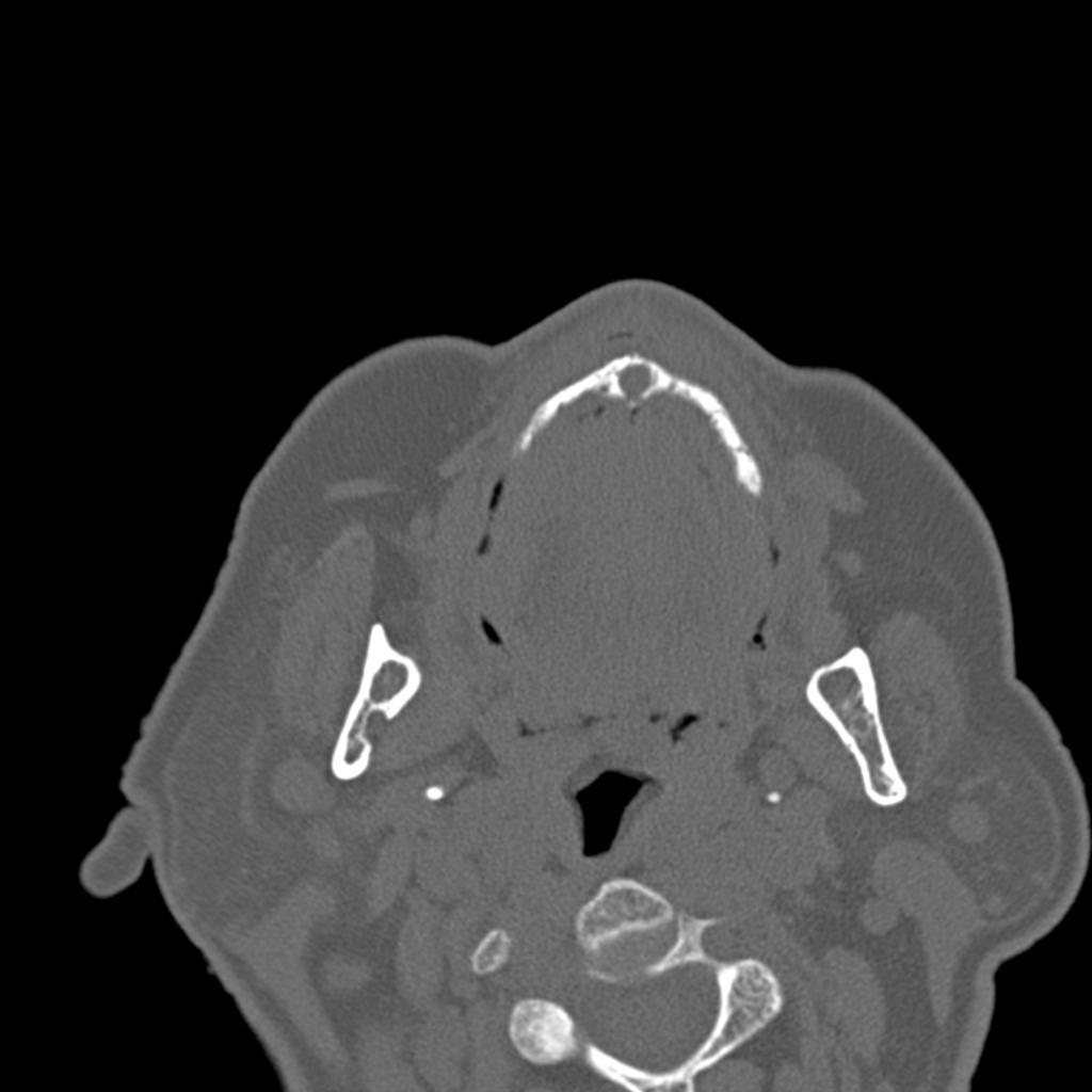Fig. 14: Nasopalatine duct cyst.