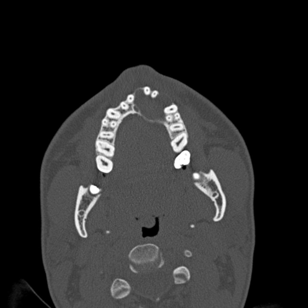 Fig. 16: Left maxillar ameloblastoma that displaces the teeth, crosses the middle