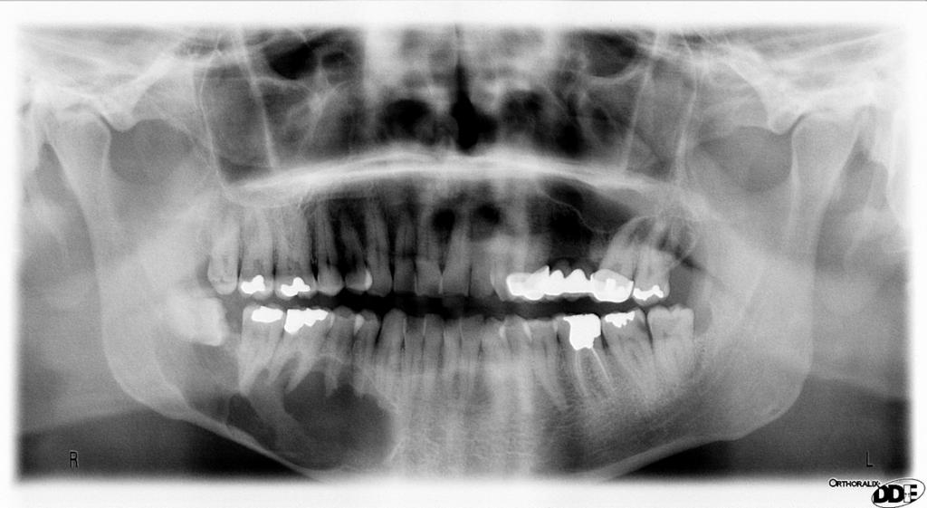 Fig. 19: Right mandibular body