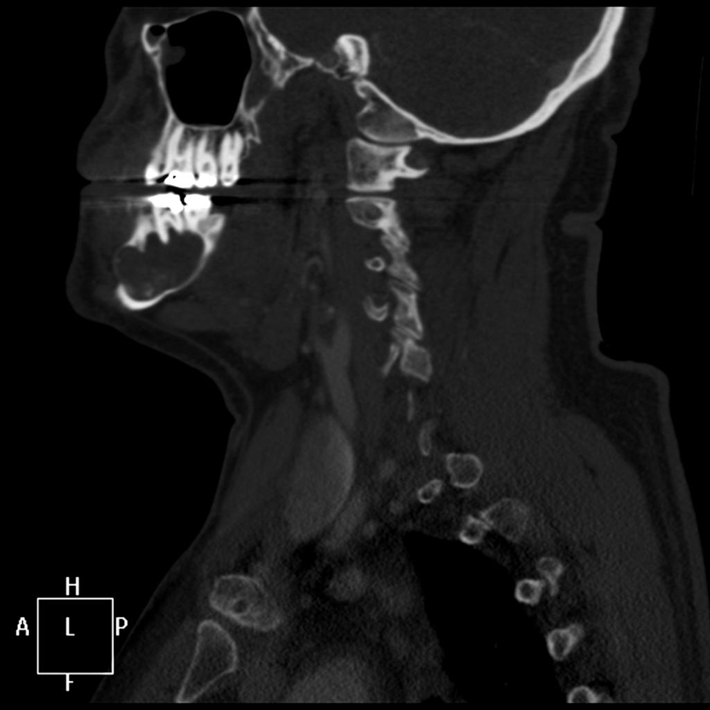 Fig. 22: Giant ameloblastoma of the right mandibular body, filled with content with areas of