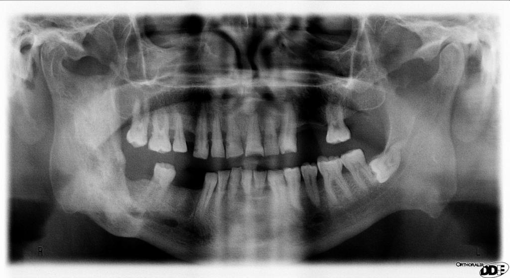 Fig. 23: Monostotic fibrosus dysplasia of the right mandibular ramus