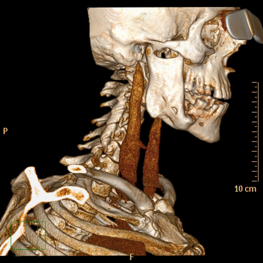 Fig. 25: Monostotic fibrous dysplasia of the right mandibular