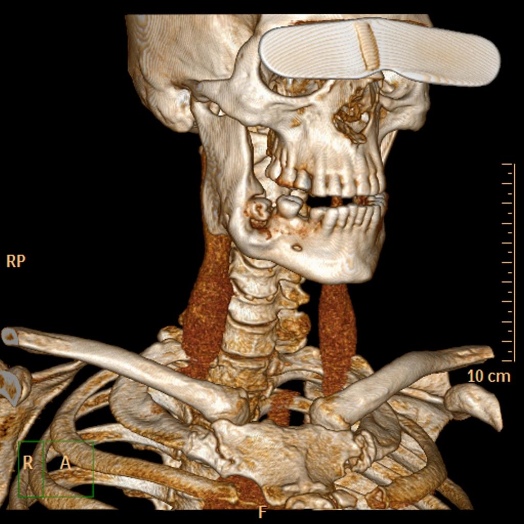 Fig. 26: Displasia Fibrosa monostótica de la rama mandibular derecha.