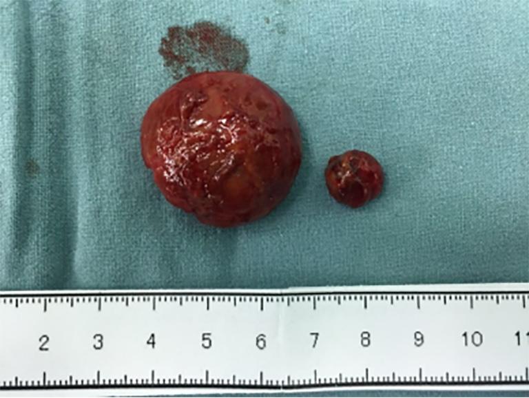Liver: Two tumors (sized 3.5 cm and 1.5 cm, respectively) were found; they had clear borders, soft texture, and intact capsule (Figure 4).