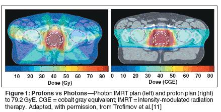 Radiotherapy for Prostate Cancer Vargas et al,ijrobp 2008, 70(3):744 Combined rectal