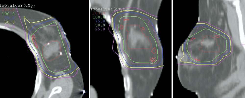 Breast (accelerated) Irradiation