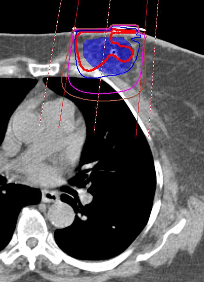 Electron Boost Isodose Plan The fuzzy edge PTV (in blue) = tumor bed plus 5 mm margin.