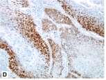 26 Primary: non-hpv related Variable staining in
