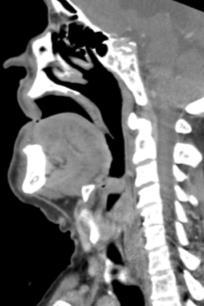OPSCCa PET/CT eases nodal detection T3 (lingual epiglottis), though ~2cm From 1 chapter to 3 7 th AJCC had 1 pharynx chapter (NP/OP/HP) 8 th edition