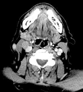 >2cm and 4cm in greatest dimension T3 = tumor >4cm or extends  advanced (invades lateral pterygoid m, pterygoid plates, lateral nasopharynx, skull