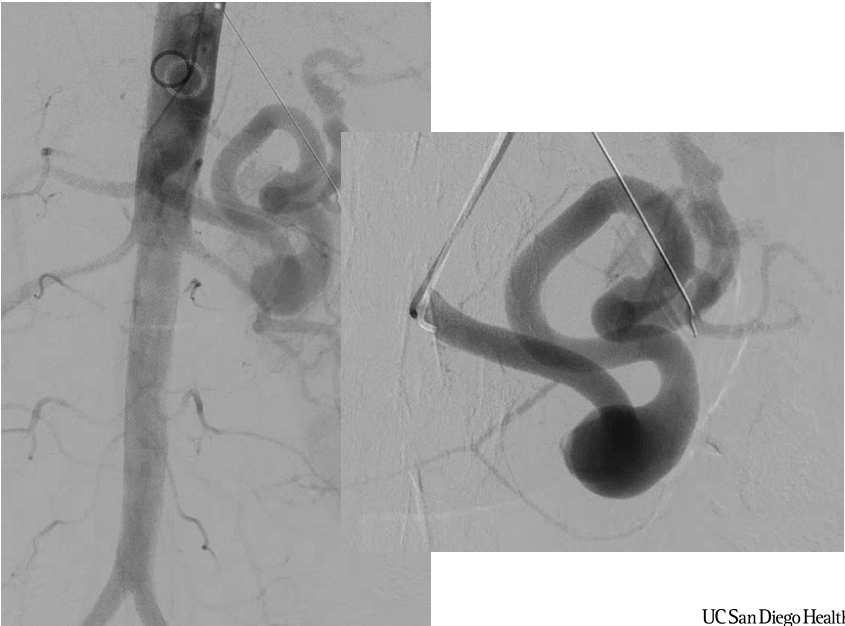 preservation) Aneurysm exclusion with arterial reconstruction Endovascular