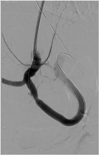 Celiac Artery Aneurysms 4% of VAA (incidence 1 in 8000) Associated with atherosclerosis, other VAA