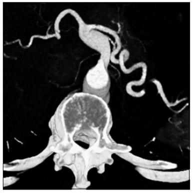 5% of visceral artery aneurysms Incidence 1 in 12,000 to 1 in 19,000 Most commonly infectious