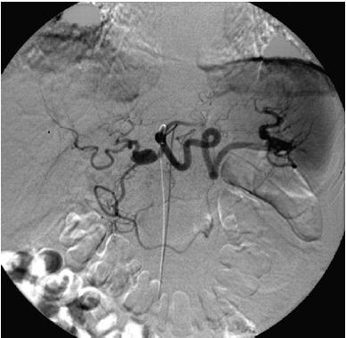 Hepatic Artery Aneurysms Hepatic artery aneurysm treatment Incidence < 0.