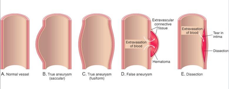 Defintions True Aneurysm Involves all three layers of the vessel.