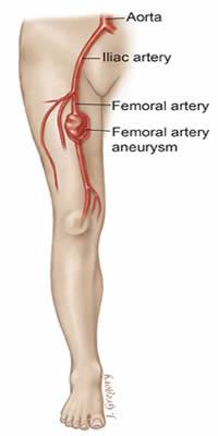 Femoral Artery Aneurysm Mostly asymptomatic, but pain may occur.