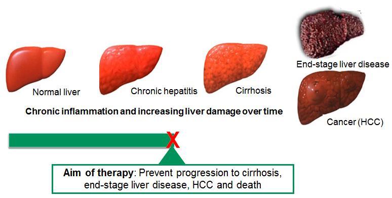 Natural history of chronic liver