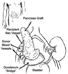 Page 9-5 Surgery for a Combined Kidney and Pancreas Transplant Your own pancreas will not be removed during surgery. These are the usual steps for a combined kidney and pancreas transplant: 1.