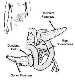 Page 9-6 Enteric Drainage Enteric drainage (bowel drained) is another way to drain the pancreas secretions. In this method, the donor duodenal bridge is sewn into a loop of your small bowel.