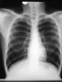 Chest X ray (CXR) X ray of the thoracic region of the body to