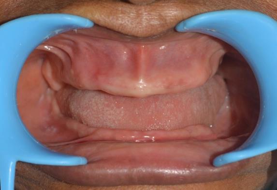 Figure 1: Intra oral view of