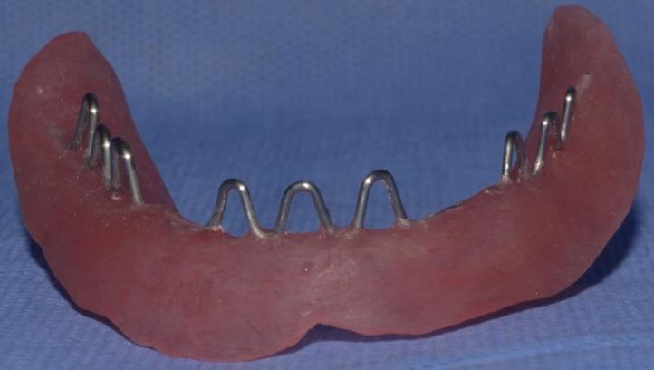 orthodontic wires bent and