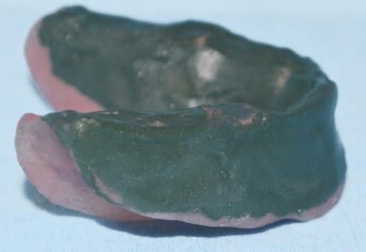 Figure 9: Molded impression on lower permanent denture base. Figure 10: Molded impression material removed and index placed. Figure 11: Wax poured into the index area.